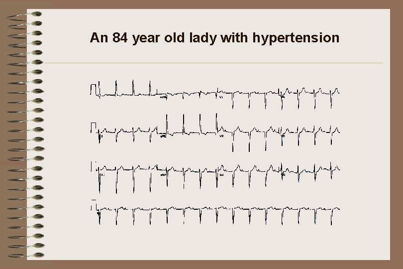 An 84 year old lady with hypertension 