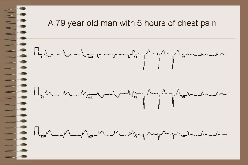A 79 year old man with 5 hours of chest pain 