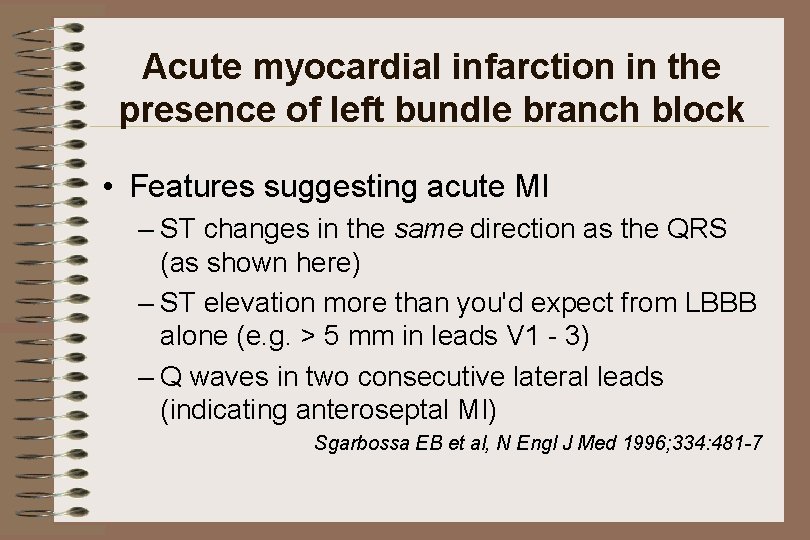 Acute myocardial infarction in the presence of left bundle branch block • Features suggesting