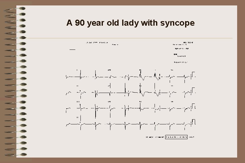 A 90 year old lady with syncope 