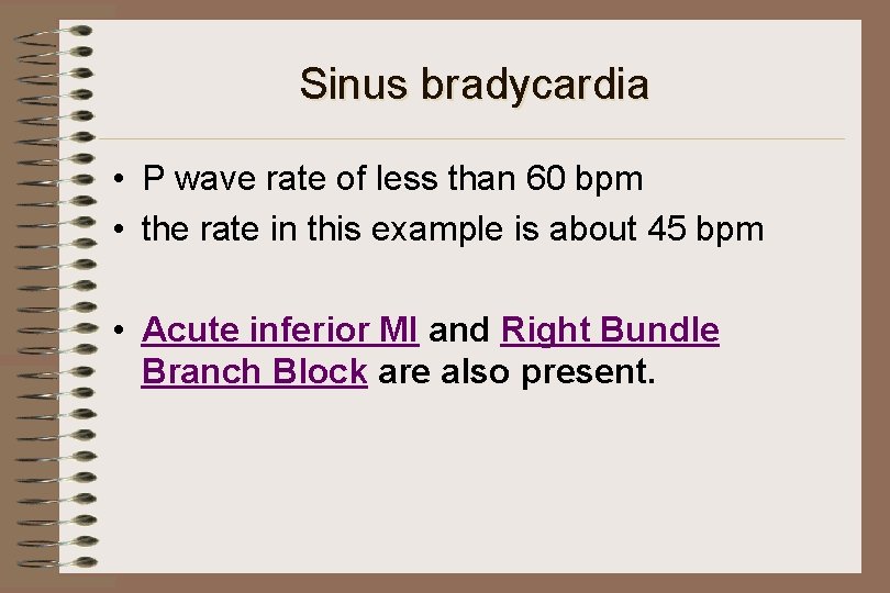 Sinus bradycardia • P wave rate of less than 60 bpm • the rate