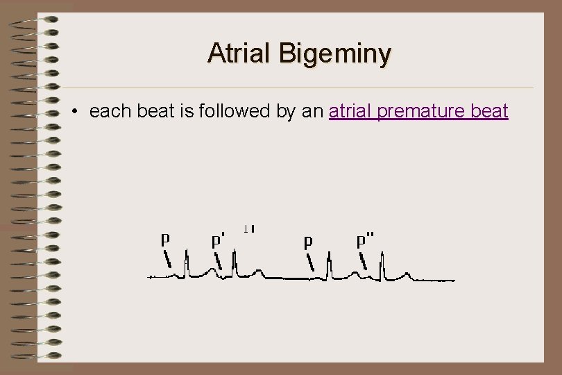 Atrial Bigeminy • each beat is followed by an atrial premature beat 