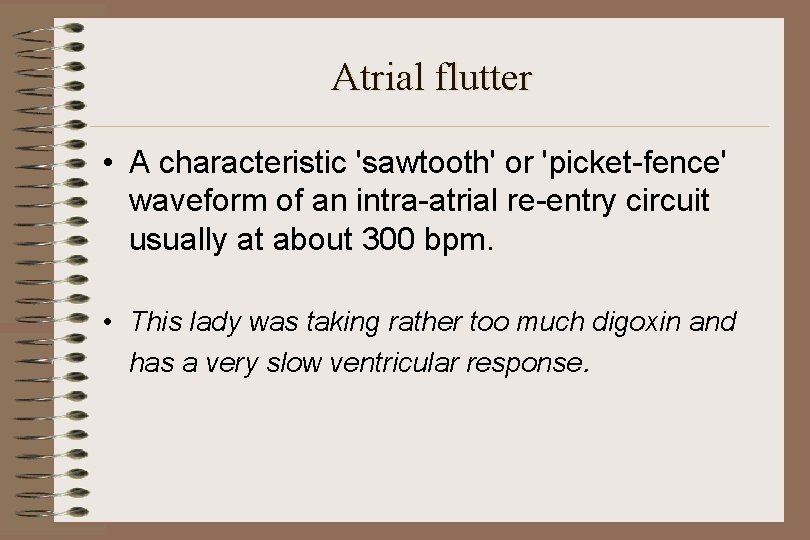 Atrial flutter • A characteristic 'sawtooth' or 'picket-fence' waveform of an intra-atrial re-entry circuit