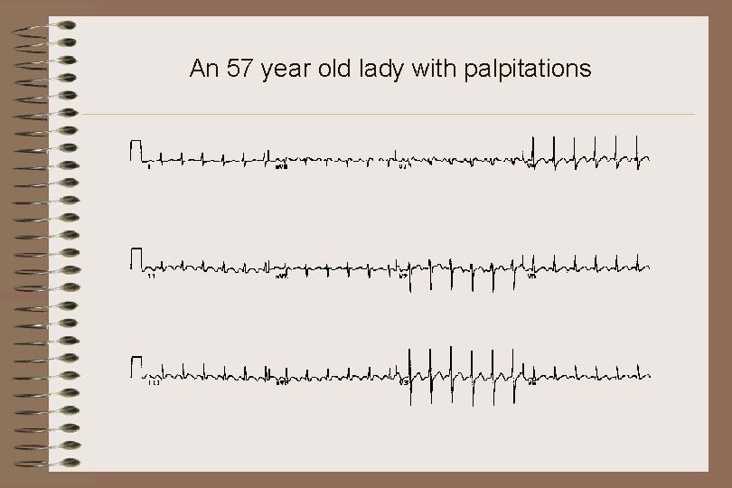 An 57 year old lady with palpitations 