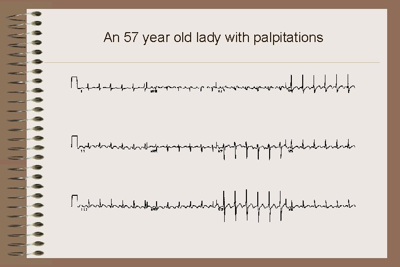 An 57 year old lady with palpitations 