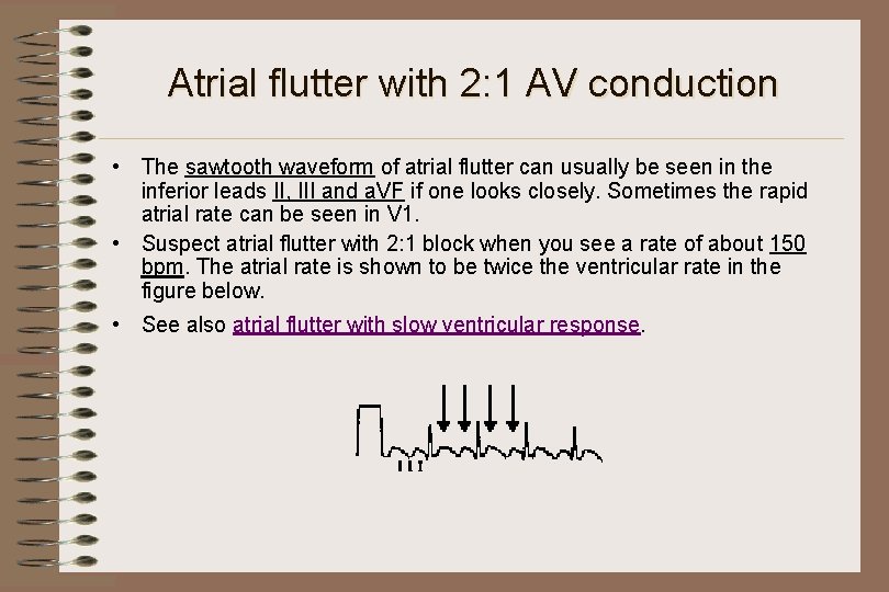 Atrial flutter with 2: 1 AV conduction • The sawtooth waveform of atrial flutter