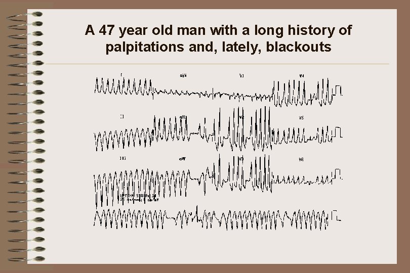 A 47 year old man with a long history of palpitations and, lately, blackouts