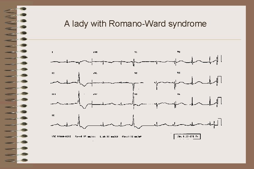 A lady with Romano-Ward syndrome 