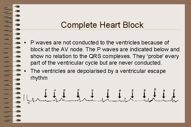 Complete Heart Block • P waves are not conducted to the ventricles because of