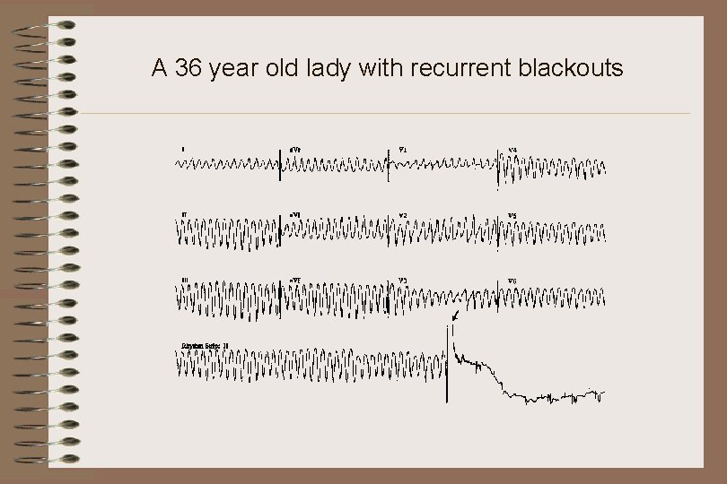 A 36 year old lady with recurrent blackouts 