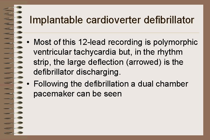 Implantable cardioverter defibrillator • Most of this 12 -lead recording is polymorphic ventricular tachycardia