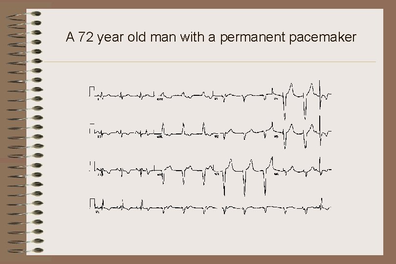 A 72 year old man with a permanent pacemaker 