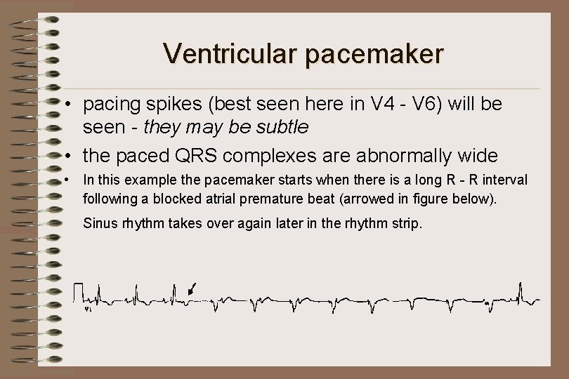 Ventricular pacemaker • pacing spikes (best seen here in V 4 - V 6)