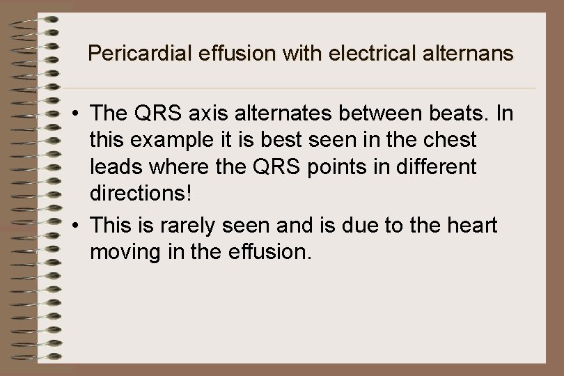 Pericardial effusion with electrical alternans • The QRS axis alternates between beats. In this