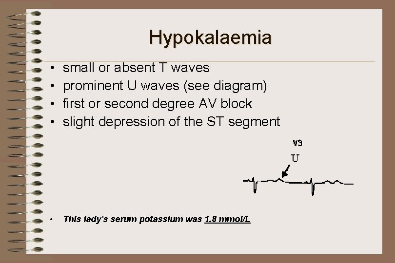 Hypokalaemia • • small or absent T waves prominent U waves (see diagram) first