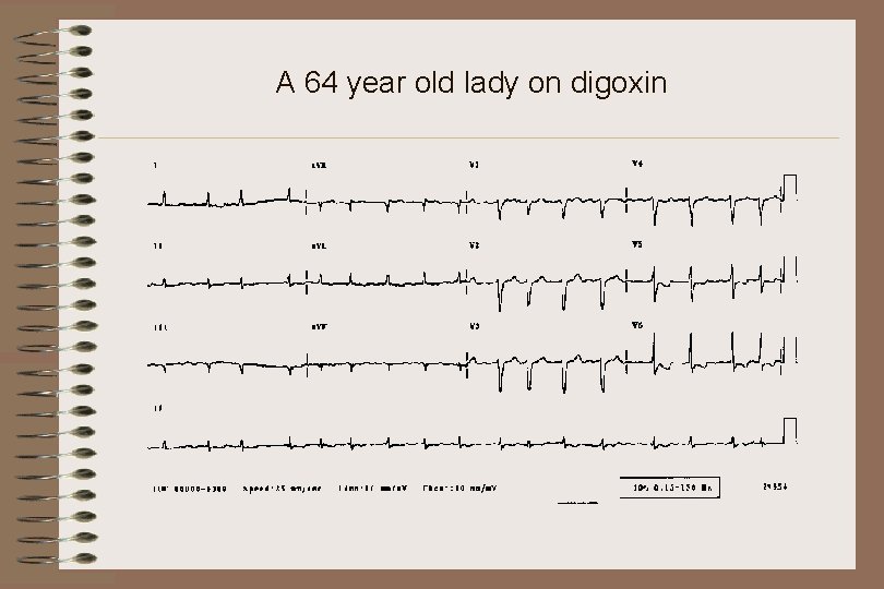 A 64 year old lady on digoxin 