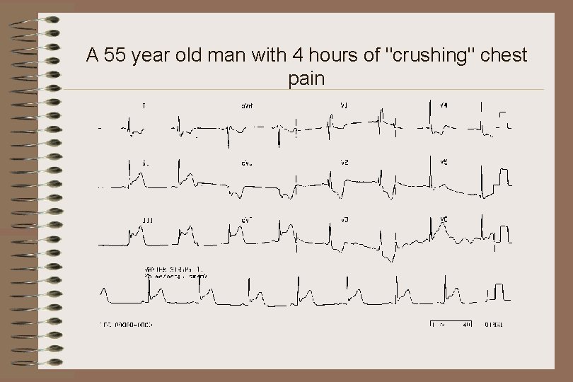 A 55 year old man with 4 hours of "crushing" chest pain 