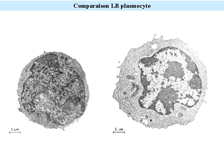 Comparaison LB plasmocyte 