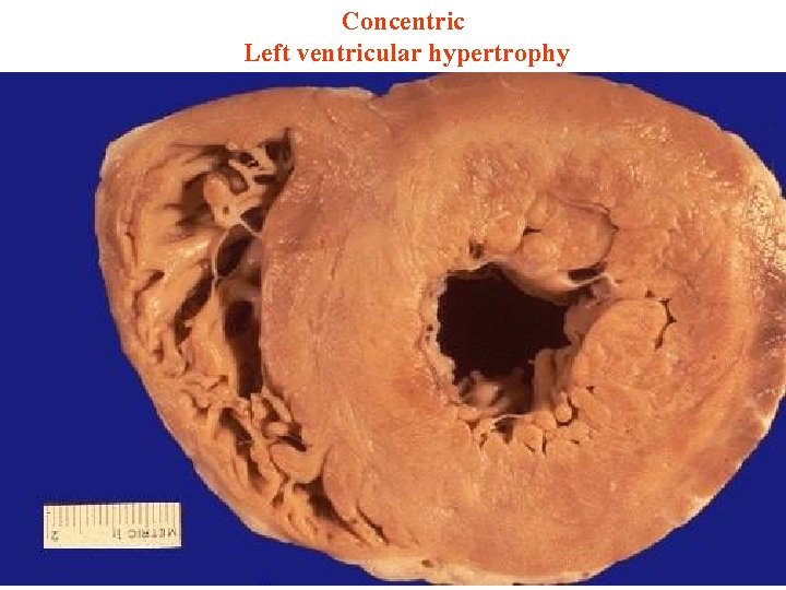 Concentric Left ventricular hypertrophy 20 
