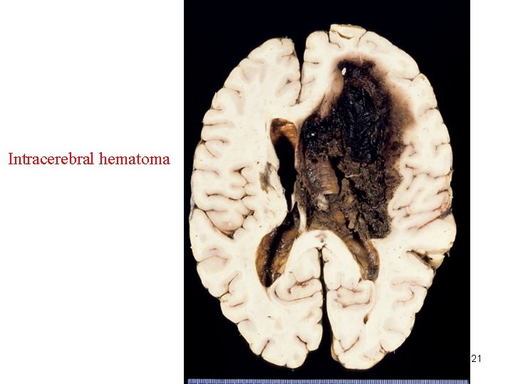 Intracerebral hematoma 21 