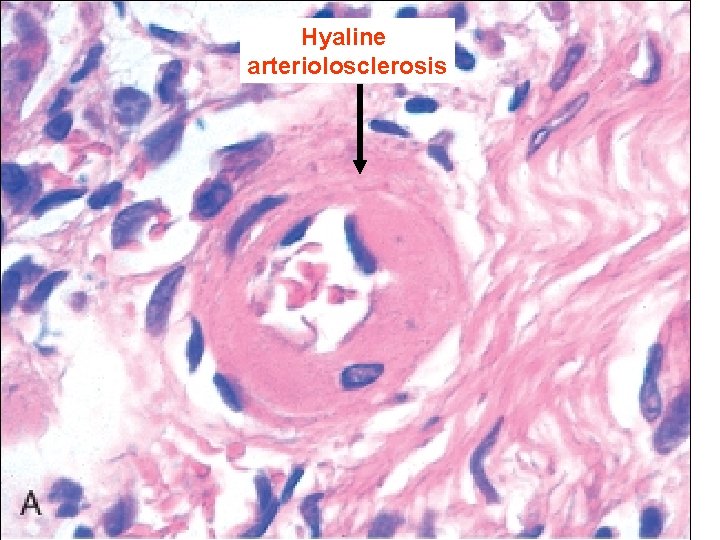Hyaline arteriolosclerosis 23 