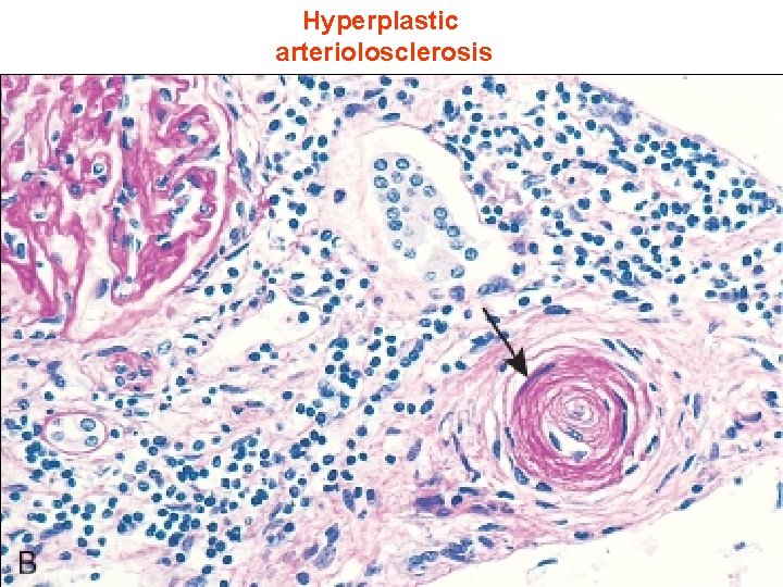 Hyperplastic arteriolosclerosis 26 