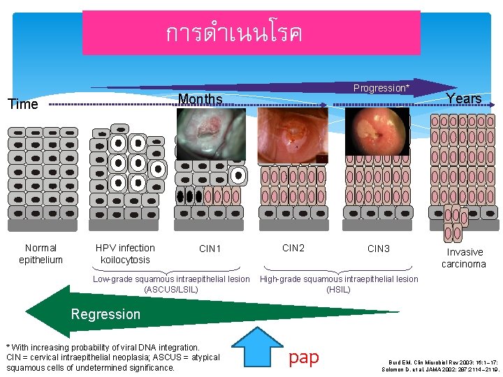 การดำเนนโรค Months Time Normal epithelium Progression* HPV infection koilocytosis CIN 1 Low-grade squamous intraepithelial