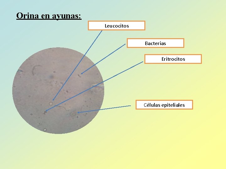 Orina en ayunas: Leucocitos Bacterias Eritrocitos Células epiteliales 