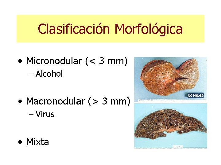 Clasificación Morfológica • Micronodular (< 3 mm) – Alcohol • Macronodular (> 3 mm)