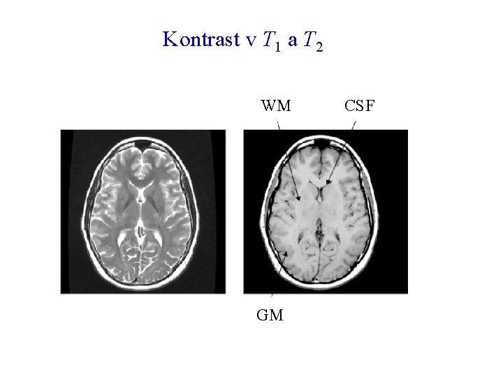 Kontrast v T 1 a T 2 WM GM CSF 