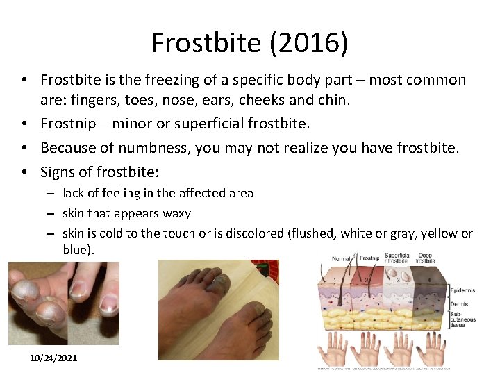 Frostbite (2016) • Frostbite is the freezing of a specific body part – most