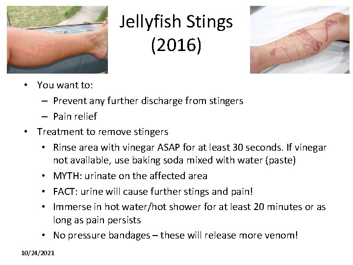 Jellyfish Stings (2016) • You want to: – Prevent any further discharge from stingers