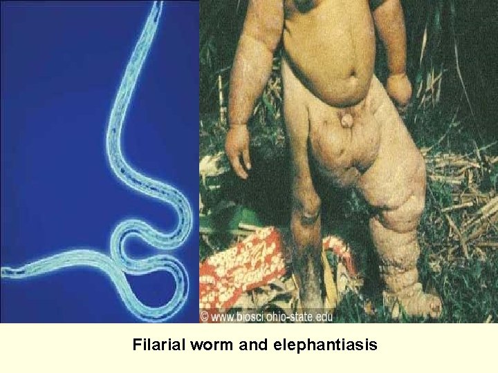 Filarial worm and elephantiasis 