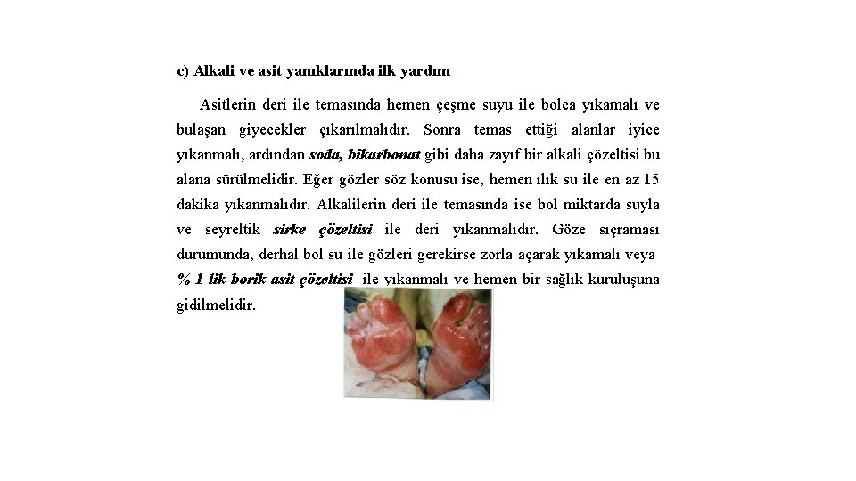 c) Alkali ve asit yanıklarında ilk yardım Asitlerin deri ile temasında hemen çeşme suyu