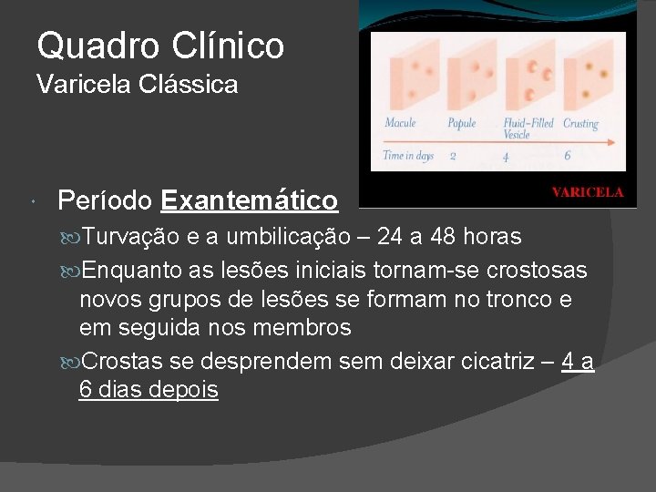 Quadro Clínico Varicela Clássica Período Exantemático Turvação e a umbilicação – 24 a 48