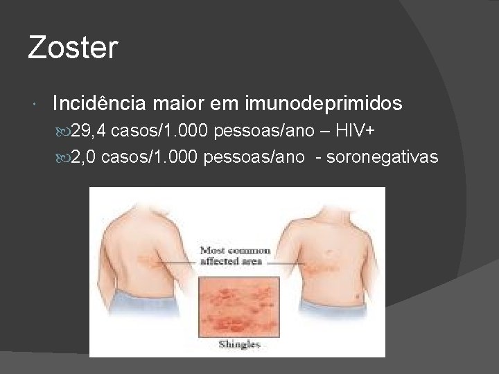 Zoster Incidência maior em imunodeprimidos 29, 4 casos/1. 000 pessoas/ano – HIV+ 2, 0