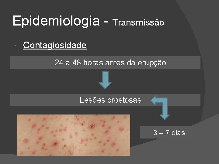Epidemiologia - Transmissão Contagiosidade 24 a 48 horas antes da erupção Lesões crostosas 3