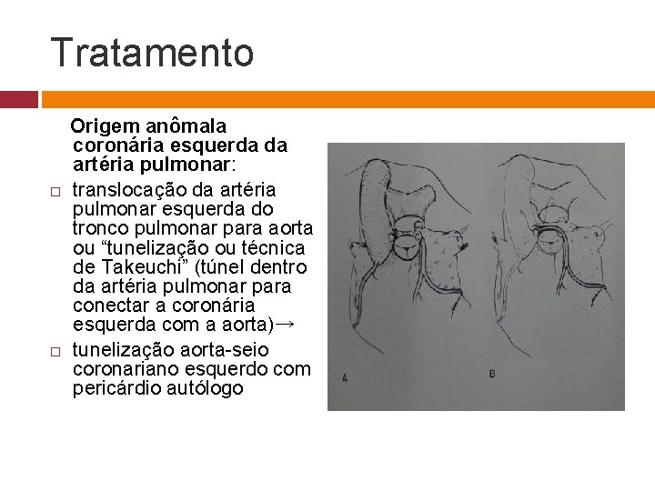 Tratamento Origem anômala coronária esquerda da artéria pulmonar: translocação da artéria pulmonar esquerda do