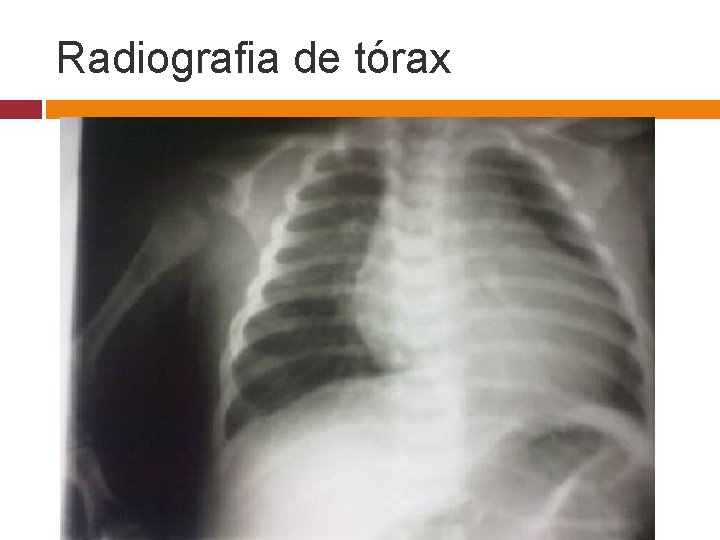 Radiografia de tórax 