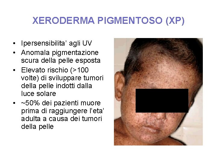 XERODERMA PIGMENTOSO (XP) • Ipersensibilita’ agli UV • Anomala pigmentazione scura della pelle esposta