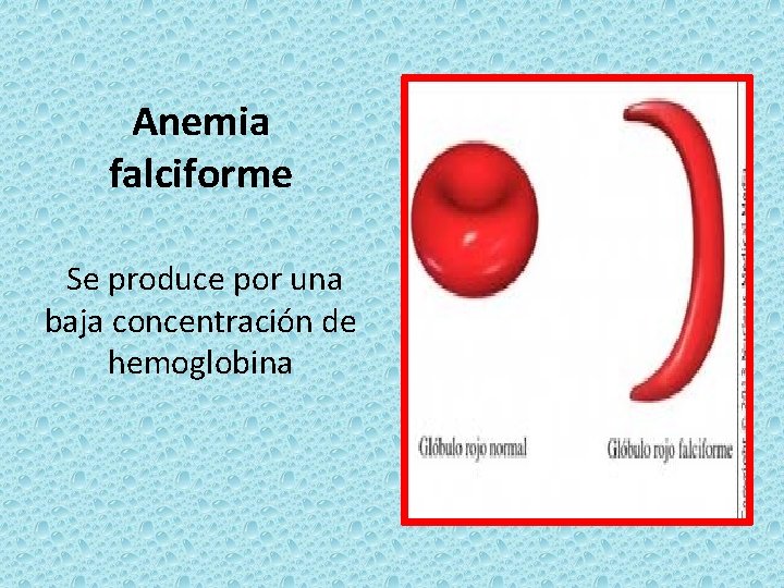 Anemia falciforme Se produce por una baja concentración de hemoglobina 