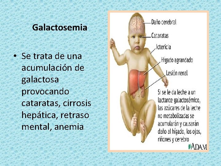 Galactosemia • Se trata de una acumulación de galactosa provocando cataratas, cirrosis hepática, retraso