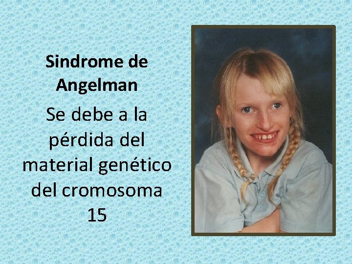 Sindrome de Angelman Se debe a la pérdida del material genético del cromosoma 15