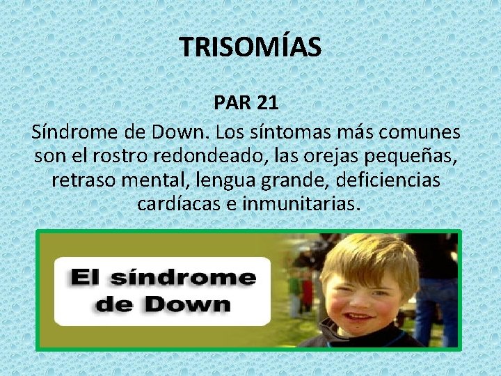 TRISOMÍAS PAR 21 Síndrome de Down. Los síntomas más comunes son el rostro redondeado,