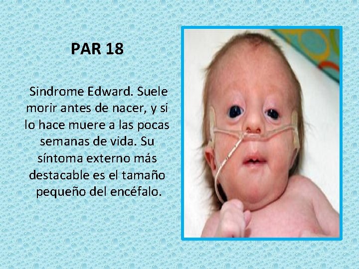 PAR 18 Sindrome Edward. Suele morir antes de nacer, y si lo hace muere