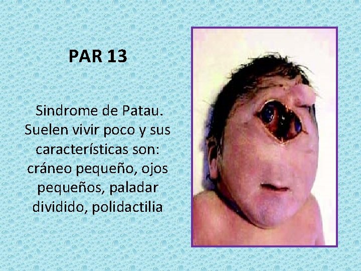 PAR 13 Sindrome de Patau. Suelen vivir poco y sus características son: cráneo pequeño,