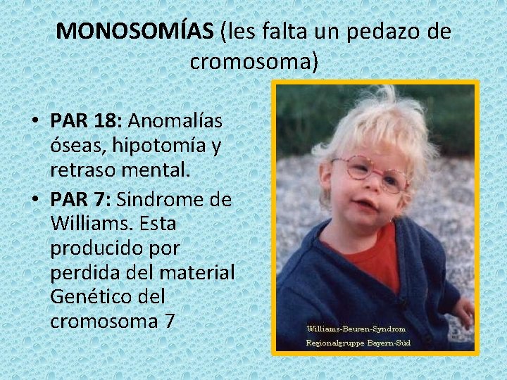 MONOSOMÍAS (les falta un pedazo de cromosoma) • PAR 18: Anomalías óseas, hipotomía y