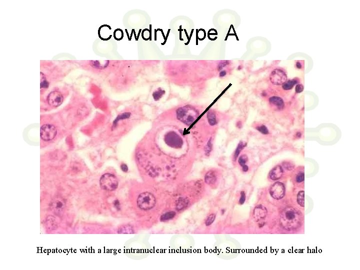 Cowdry type A Hepatocyte with a large intranuclear inclusion body. Surrounded by a clear