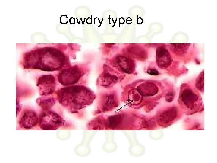 Cowdry type b 