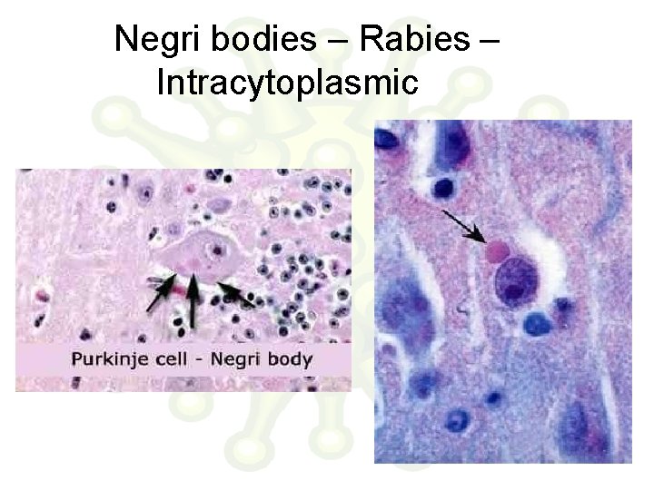 Negri bodies – Rabies – Intracytoplasmic 